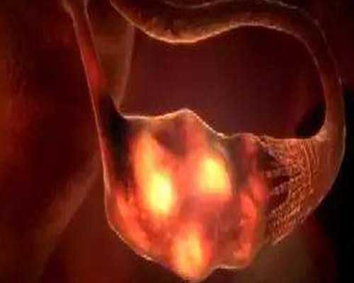 绵阳中心医院做试管婴儿 绵阳试管婴儿医院选择经验 ‘女人得了梅毒有什么症