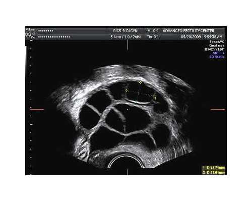 武汉协和医院可以做供卵试管婴儿吗?,武汉供卵试管哪家专业？武汉供卵试管口